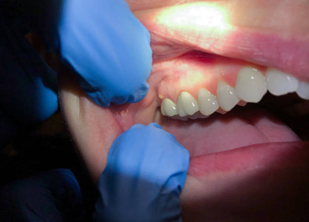 Best Emergency Tooth Extraction in Double Oak, TX